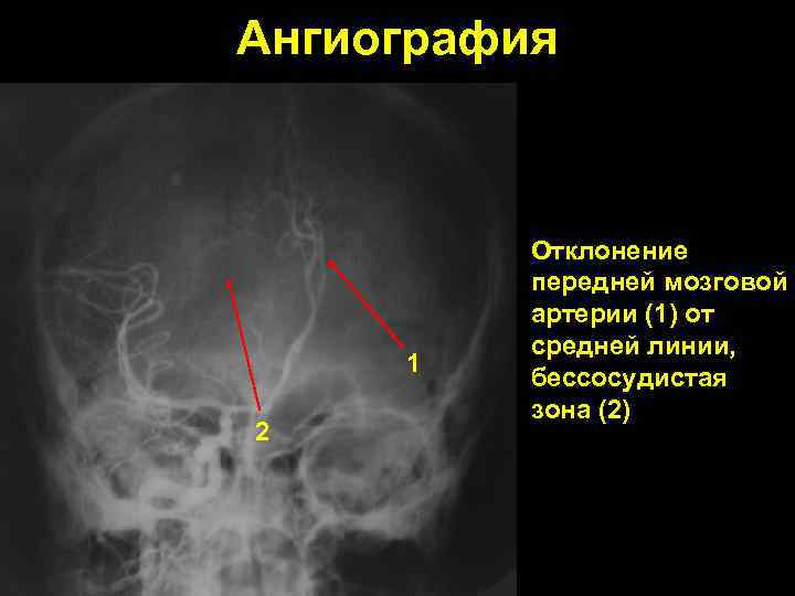 Ангиография 1 2 Отклонение передней мозговой артерии (1) от средней линии, бессосудистая зона (2)