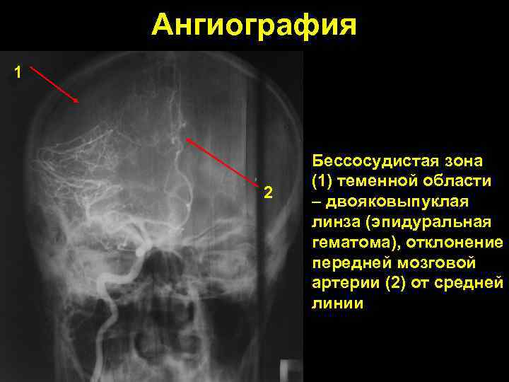 Ангиография 1 2 Бессосудистая зона (1) теменной области – двояковыпуклая линза (эпидуральная гематома), отклонение