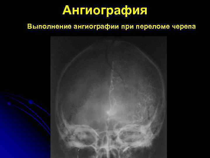 Ангиография Выполнение ангиографии при переломе черепа 