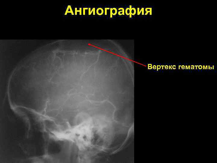 Ангиография Вертекс гематомы 