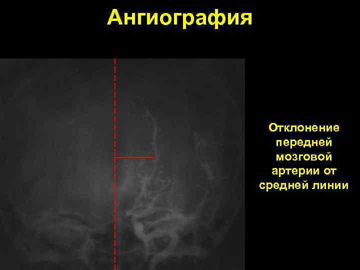 Ангиография Отклонение передней мозговой артерии от средней линии 