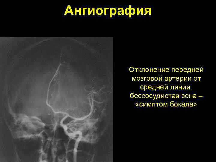 Ангиография Отклонение передней мозговой артерии от средней линии, бессосудистая зона – «симптом бокала» 