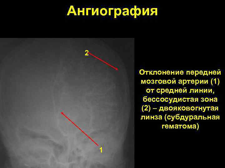 Ангиография 2 Отклонение передней мозговой артерии (1) от средней линии, бессосудистая зона (2) –