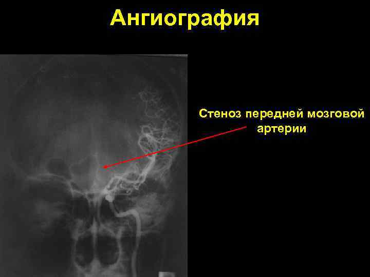 Ангиография Стеноз передней мозговой артерии 