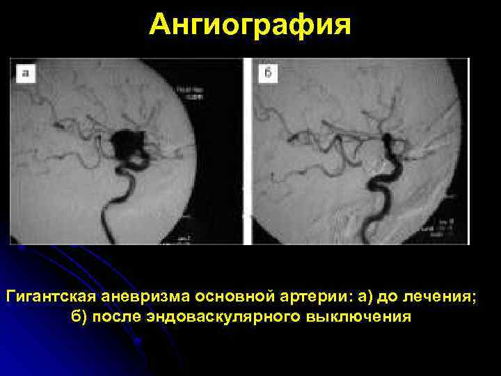 Ангиография Гигантская аневризма основной артерии: а) до лечения; б) после эндоваскулярного выключения 
