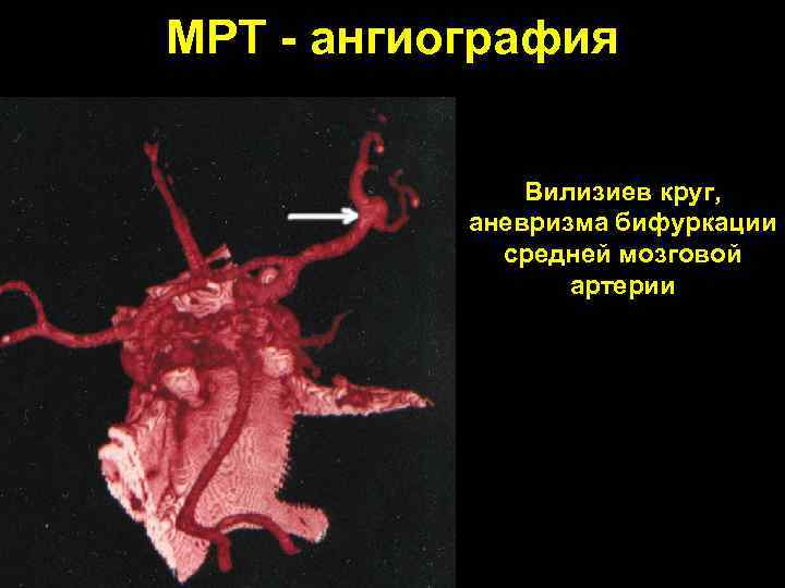 МРТ - ангиография Вилизиев круг, аневризма бифуркации средней мозговой артерии 