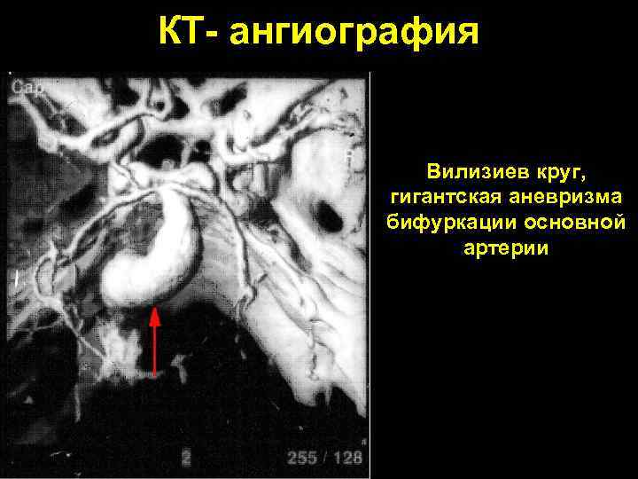 КТ- ангиография Вилизиев круг, гигантская аневризма бифуркации основной артерии 