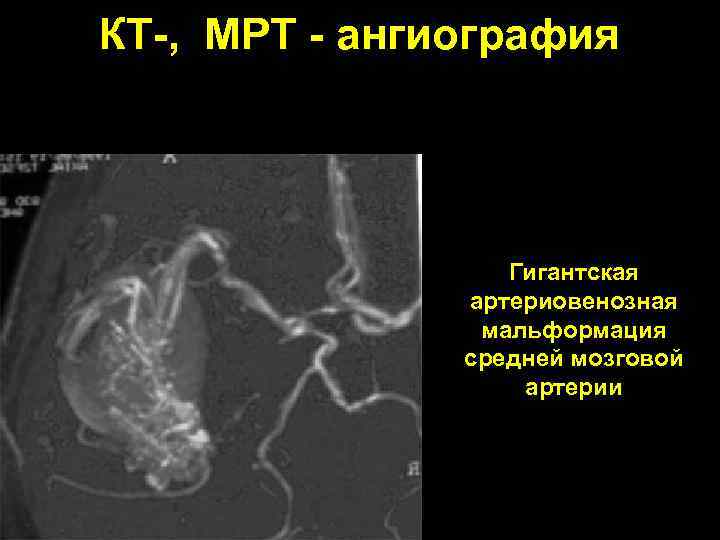 КТ-, МРТ - ангиография Гигантская артериовенозная мальформация средней мозговой артерии 