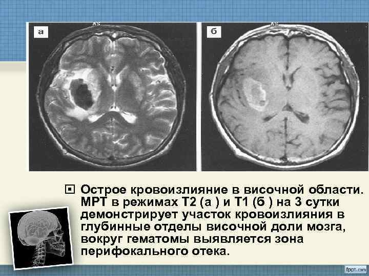  Острое кровоизлияние в височной области.  МРТ в режимах Т 2 (а )