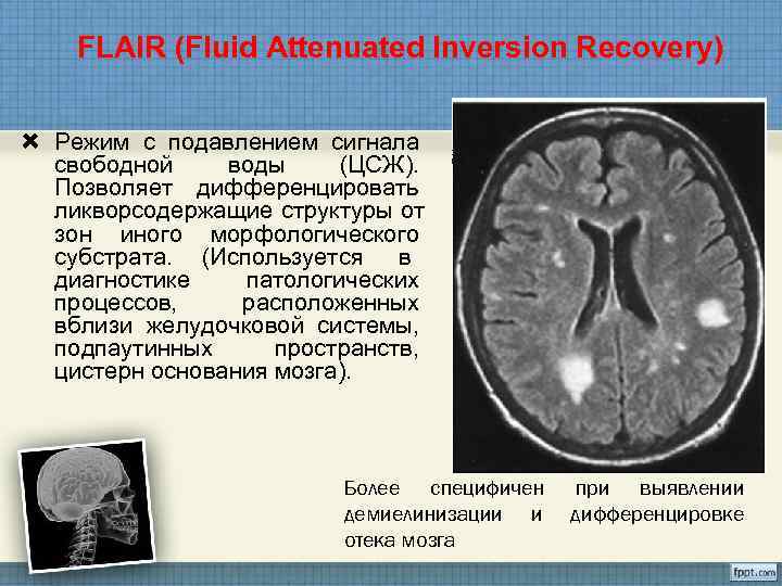   FLAIR (Fluid Attenuated Inversion Recovery) Режим с подавлением сигнала  свободной воды