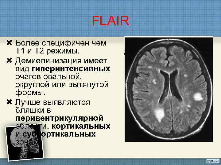 Очаги повышенной интенсивности