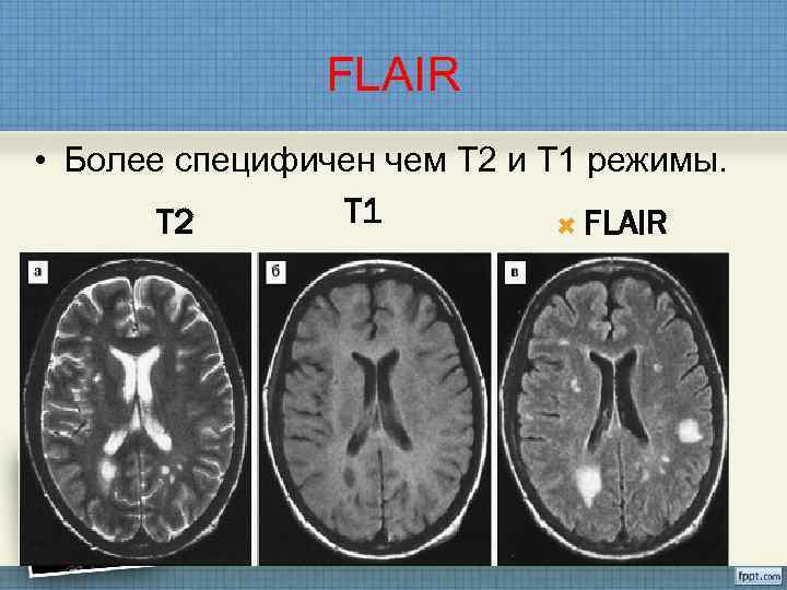 Т2ч2. Т1 и т2 взвешенные изображения в мрт. Мрт т1 и т2 режимы что это. Т2 Flair на мрт.