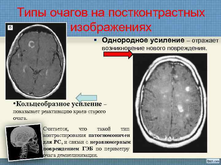  Типы очагов на постконтрастных  изображениях      § Однородное