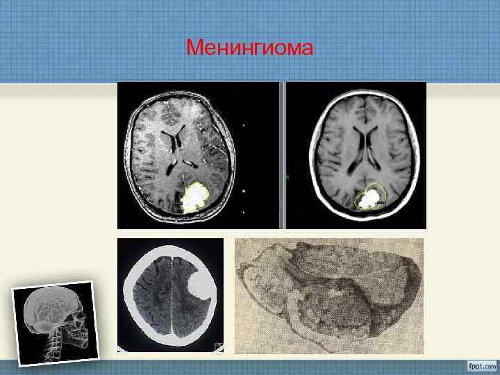 Менингиома 