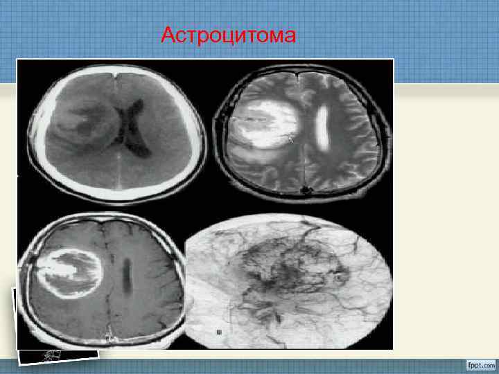 Астроцитома 