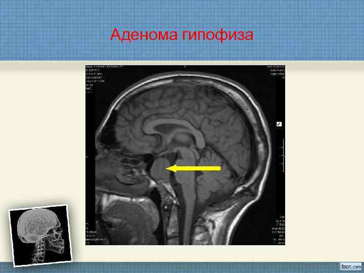 Фото людей с аденомой гипофиза