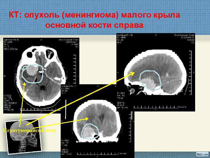 Менингиома на кт