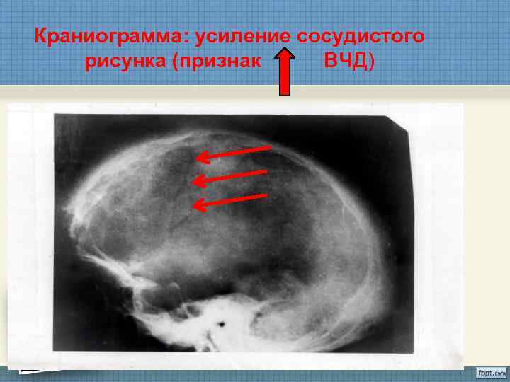 Усиление сосудистого рисунка