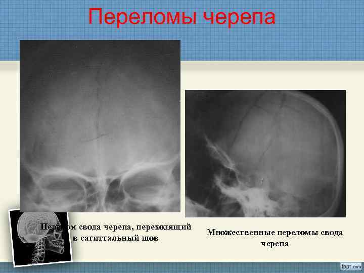 Линейный перелом свода черепа