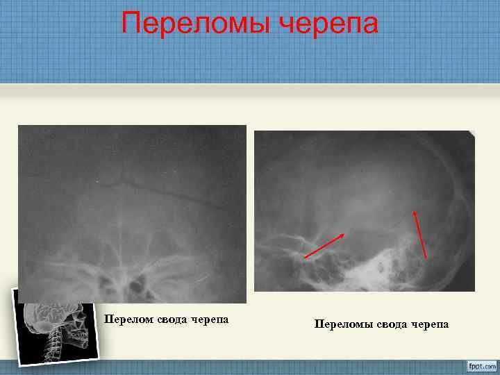 Картинки перелом черепа