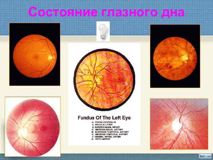 Состояние глазного дна 