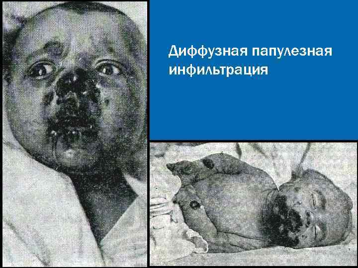 Диффузная папулезная инфильтрация Диффузная папулезная инфильтрация
