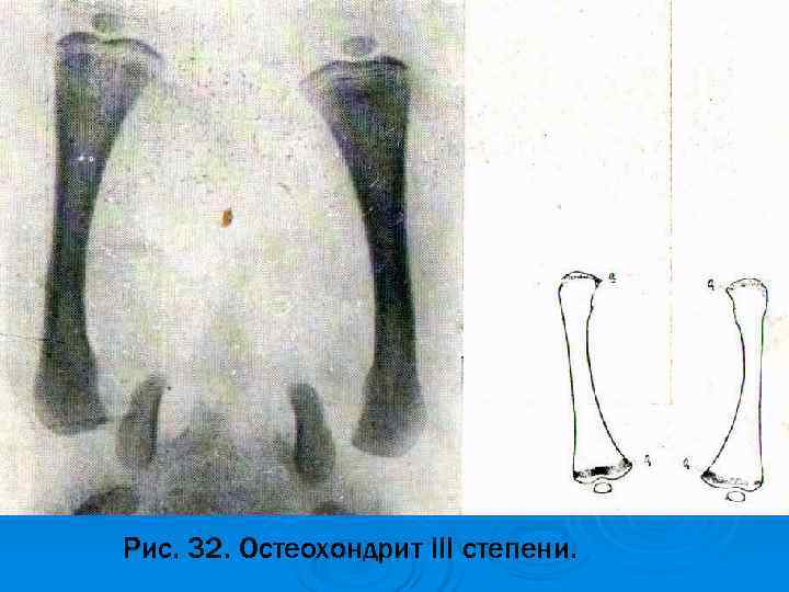Рис. 32. Остеохондрит III степени. Рис. 32. Остеохондрит III степени.