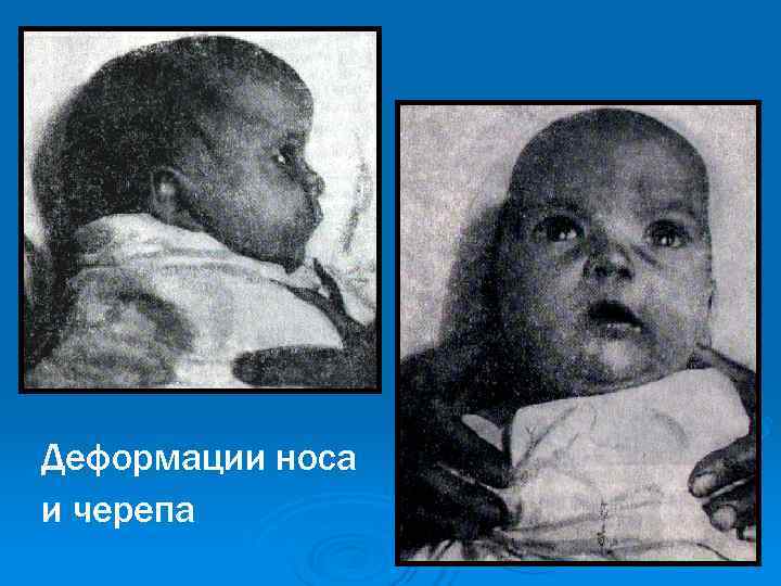 Деформации носа и черепа Деформации носа и черепа
