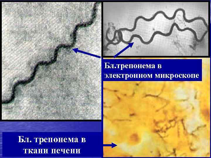    Бл. трепонема в    электронном микроскопе Бл. трепонема в