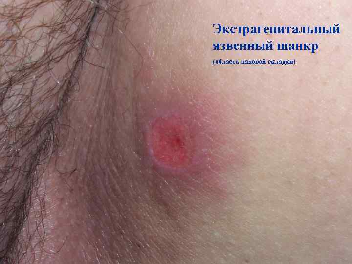 Экстрагенитальный язвенный шанкр (область паховой складки) 