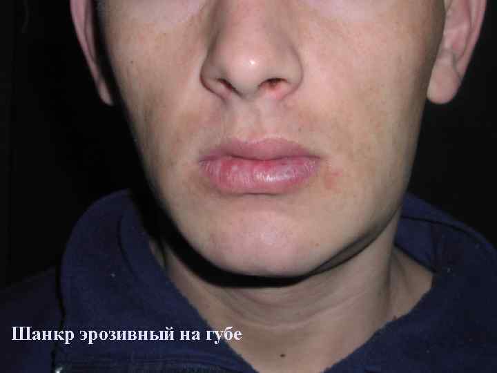 Шанкр эрозивный на губе 