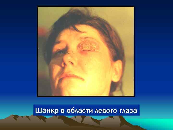 Шанкр в области левого глаза 
