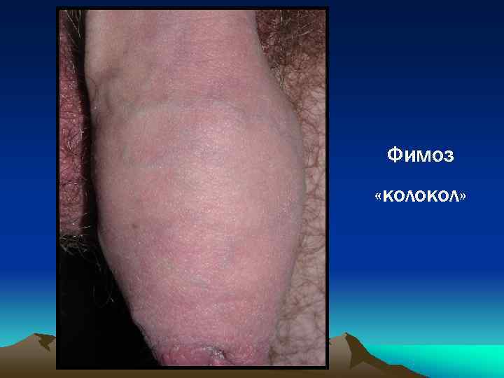  Фимоз «колокол» 