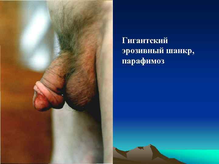 Гигантский эрозивный шанкр, парафимоз 