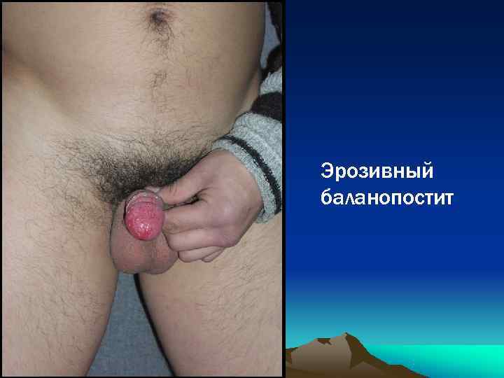Эрозивный баланопостит 