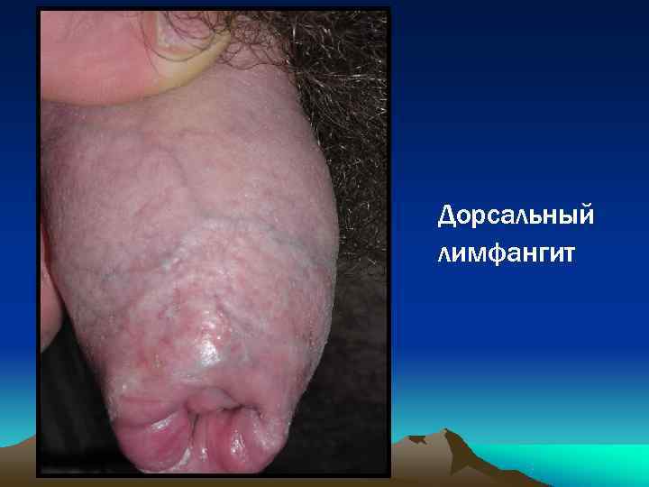 Дорсальный лимфангит 