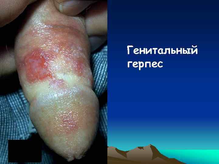 Генитальный герпес 