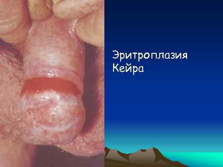 Эритроплазия Кейра 