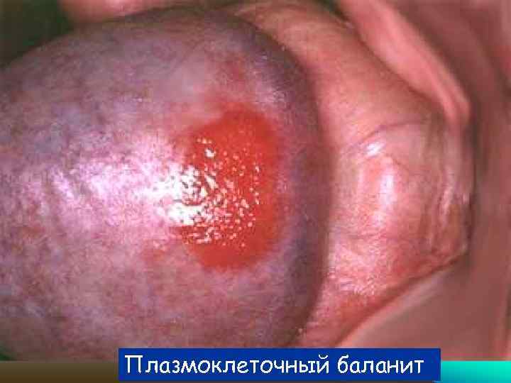 Плазмоклеточный баланит 
