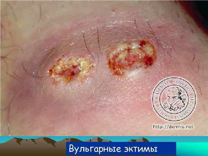 Вульгарные эктимы 