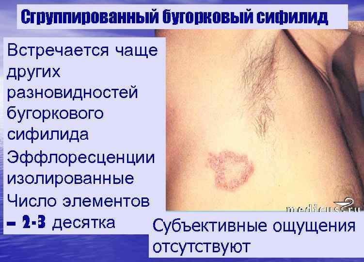  Сгруппированный бугорковый сифилид Встречается чаще других разновидностей бугоркового сифилида Эффлоресценции изолированные Число элементов