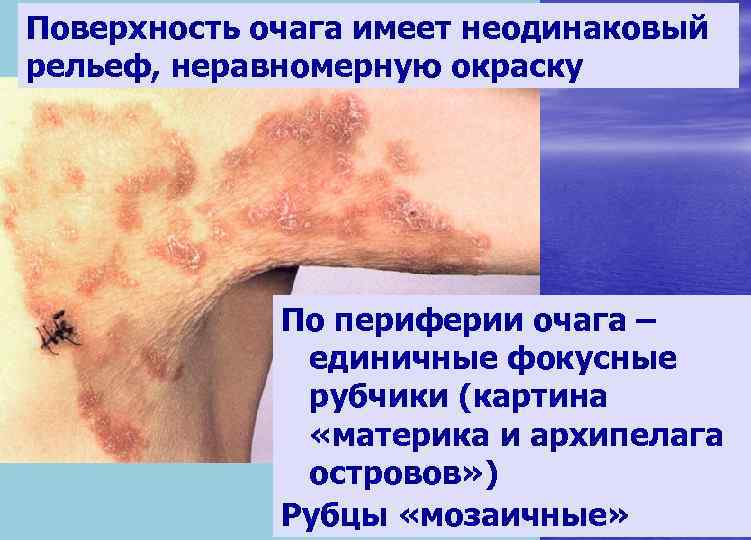 Поверхность очага имеет неодинаковый рельеф, неравномерную окраску   По периферии очага – 