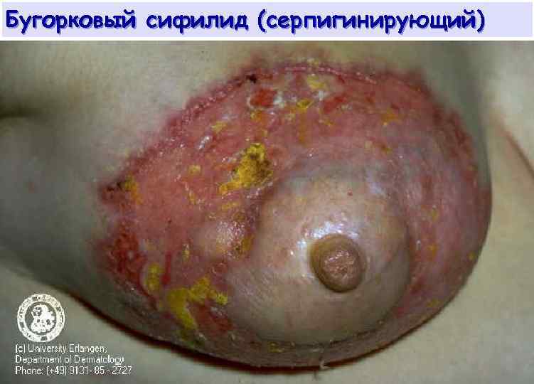 Бугорковый сифилид (серпигинирующий) 