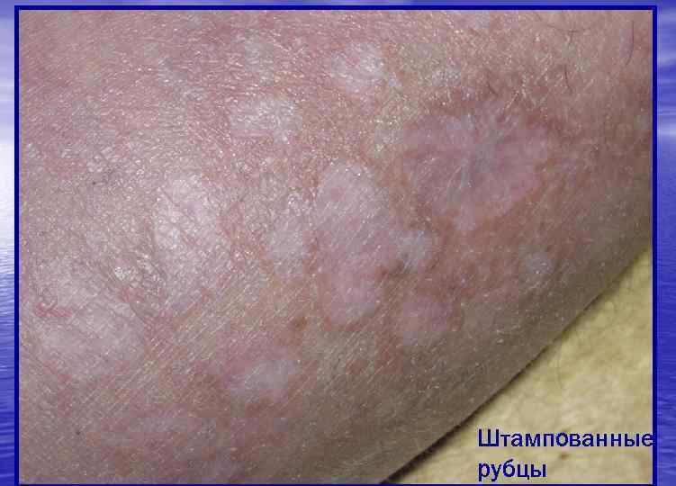 Штампованные рубцы 
