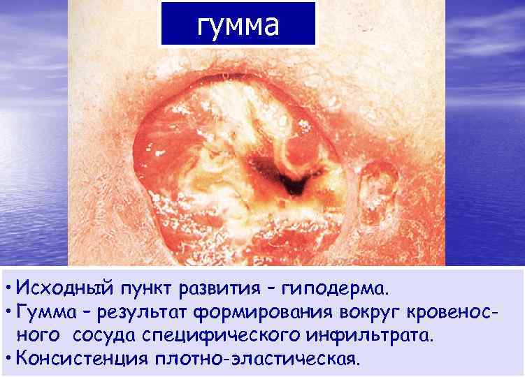    гумма • Исходный пункт развития – гиподерма.  • Гумма –