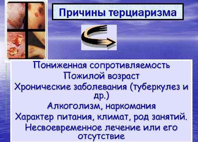    Причины терциаризма  Пониженная сопротивляемость  Пожилой возраст Хронические заболевания (туберкулез