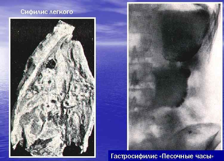 Сифилис легкого    Гастросифилис «Песочные часы» 