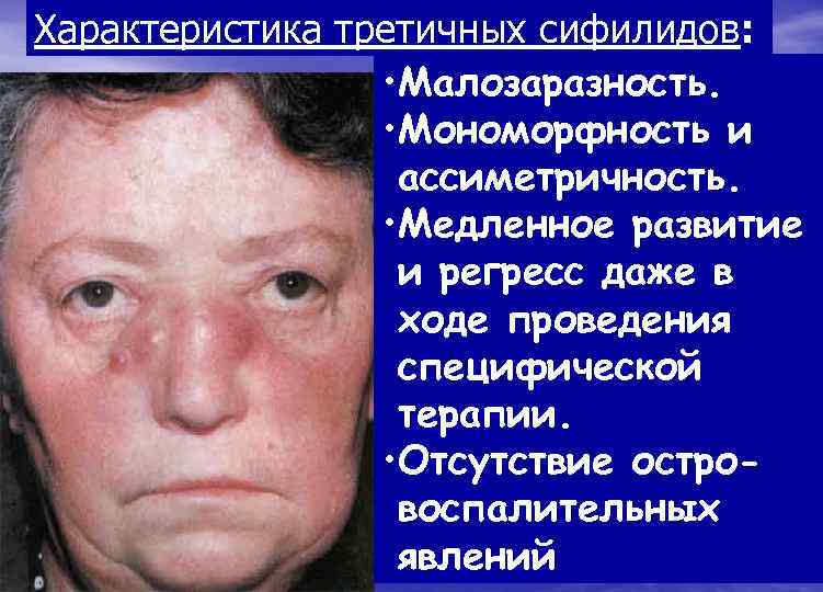 Характеристика третичных сифилидов:    • Малозаразность.    • Мономорфность и