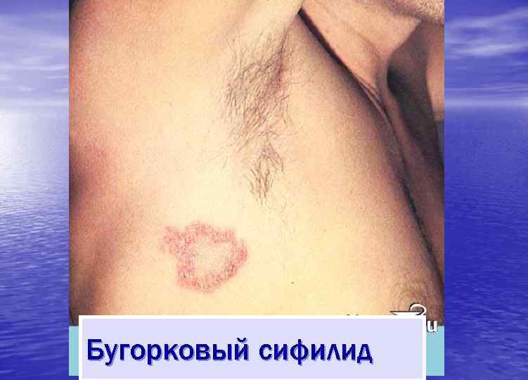 Бугорковый сифилид 