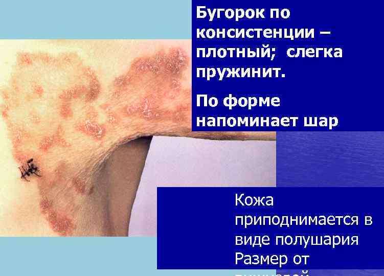 Бугорок по консистенции – плотный; слегка пружинит. По форме напоминает шар  Кожа 